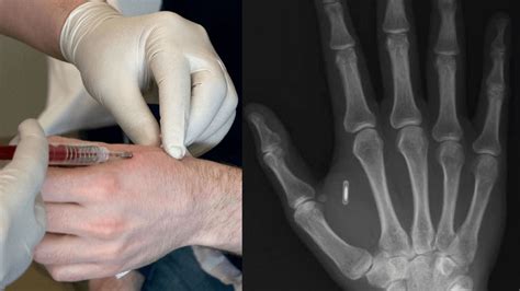 inserting rfid chips into employees|microchips for workplace safety.